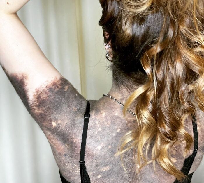 Woman with large unique birth marks covering her back and arm, showcasing amazing and interesting natural skin patterns.
