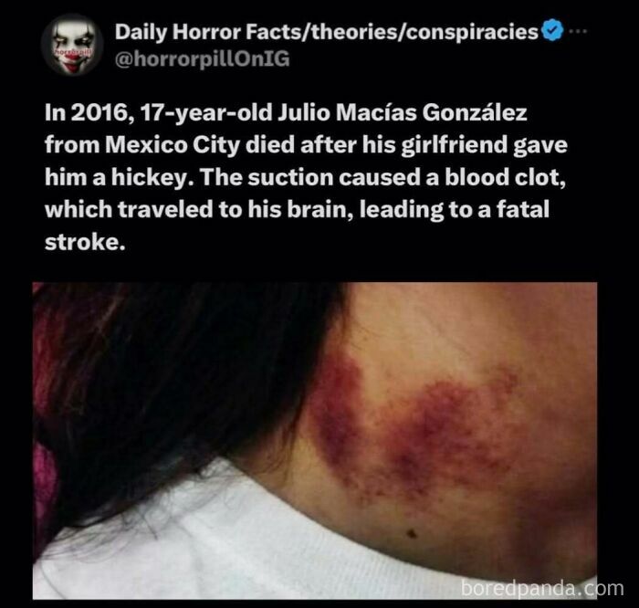 Horrifying bruise on neck causing fatal stroke, shared by horror pill online group facts and theories account.