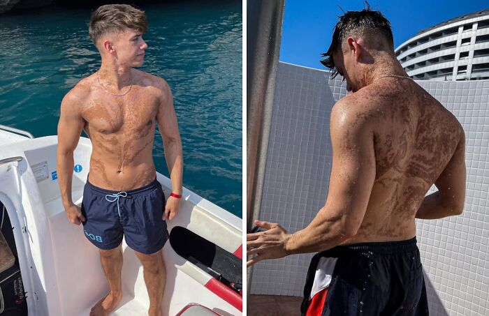 Young man with unique and interesting birthmarks covering his upper body and back in outdoor settings.