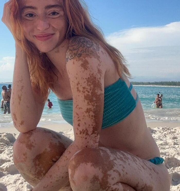 Young woman with extensive birth marks on her arms and legs wearing a swimsuit at the beach under a clear sky