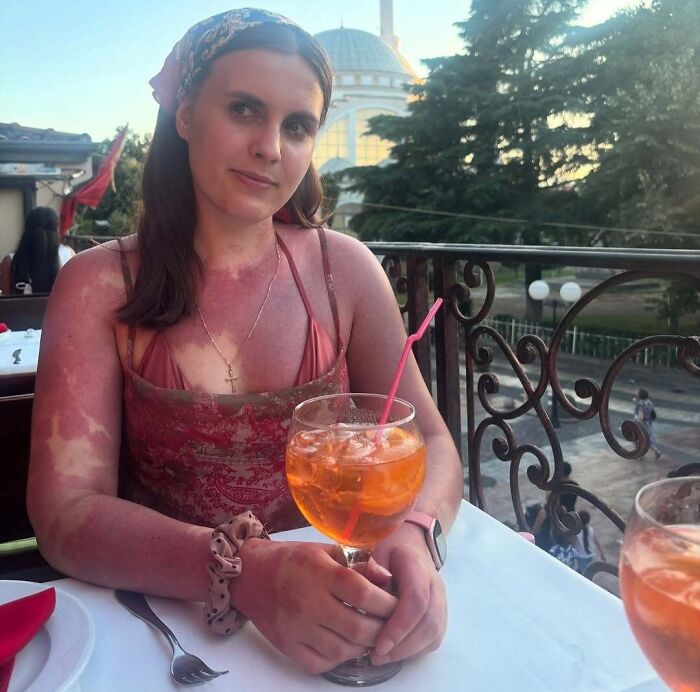 Young woman with distinctive birth marks on her arms and chest enjoying a drink at an outdoor restaurant.