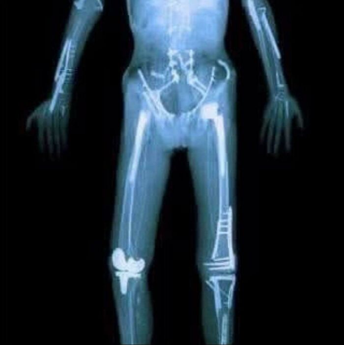 X-ray image showing multiple orthopedic implants in a human lower body and arms