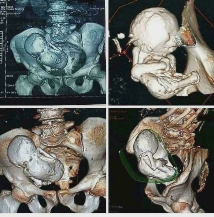 Scary 3D CT scan images showing baby in abnormal pelvic position