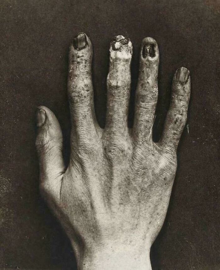 Close-up of a gnarled, injured hand with missing and deformed fingernails, black-and-white medical pics photo