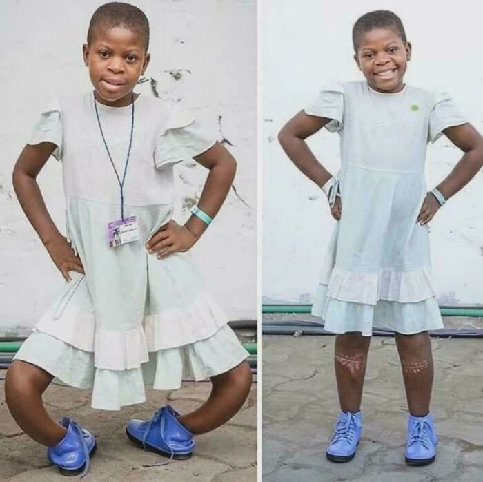 Young girl wearing a white dress and blue shoes showing visible medical scars on her legs in a fascinating medical photo.