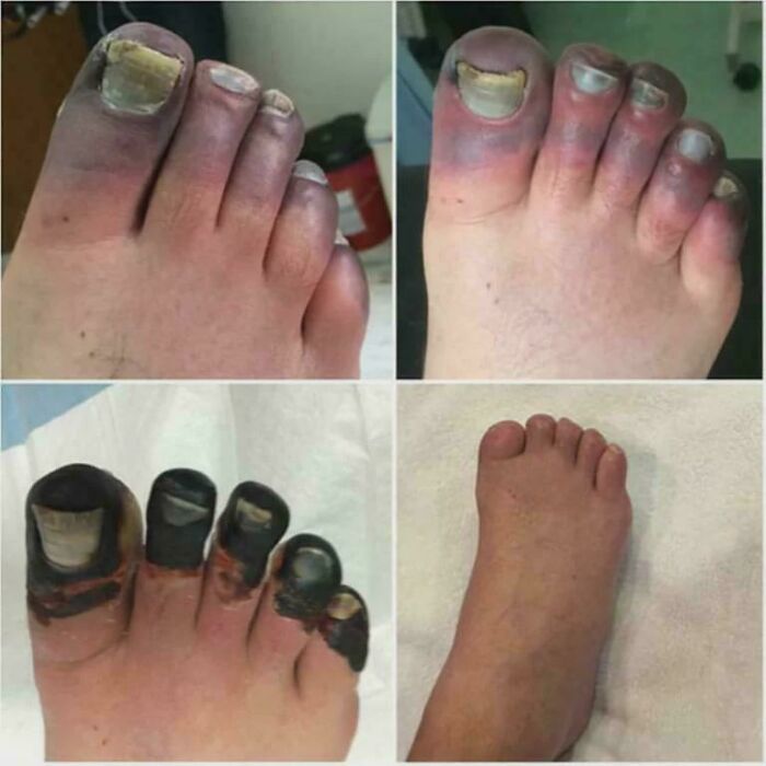 Severe Frostbite In Extreme Altitude Climber (Mt. Everest)