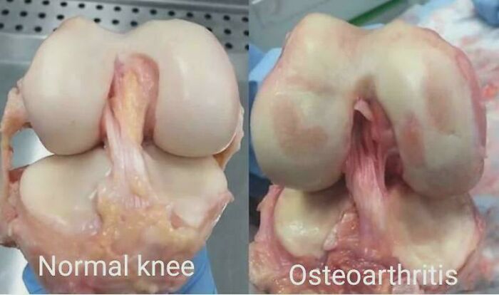 Side-by-side dissected knee specimens showing normal vs osteoarthritis cartilage damage — medical pics