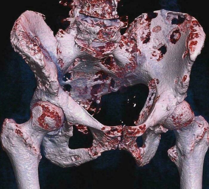 Medical pics: 3D pelvic CT showing extensive lytic destructive lesions of the hips and pelvis