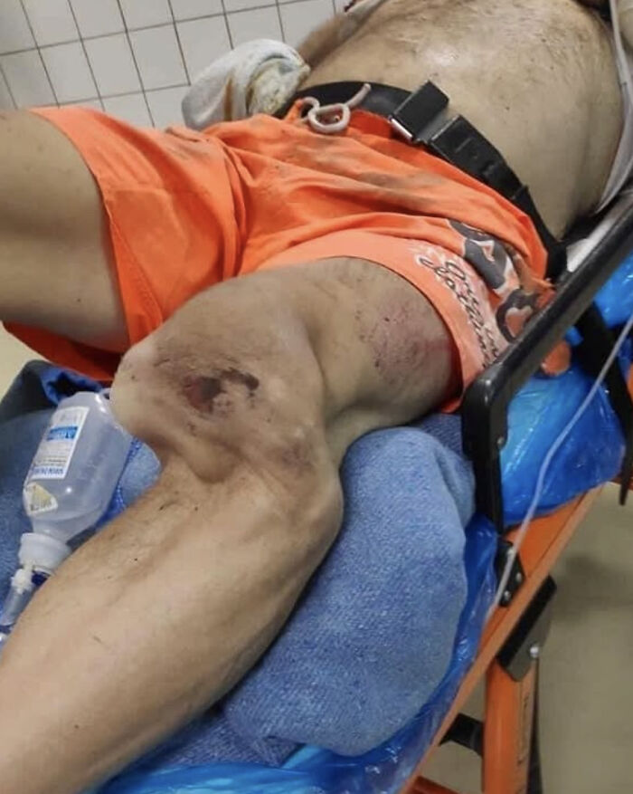 Injured adult leg with open knee wound on stretcher, orange shorts and IV bag, medical pics
