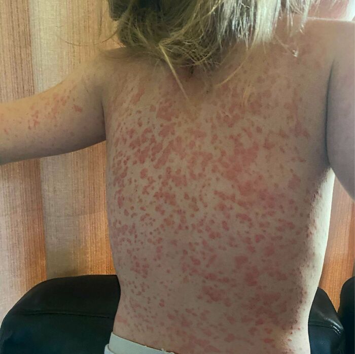 Person's back and shoulders covered in widespread red blotchy rash, medical pics of an alarming skin reaction.