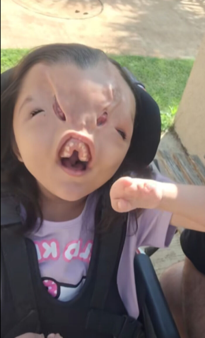 Young child with facial differences and dental irregularities in a wheelchair outdoors, candid portrait, medical pics