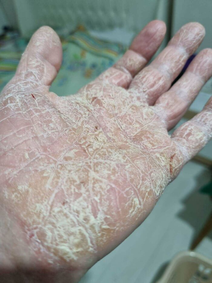 Close-up of a palm with severe dry, peeling skin and small cracks, medical pics of a skin condition