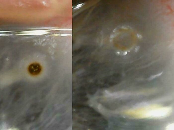 Close-up of translucent tissue with two small round brown lesions, medical pics detail