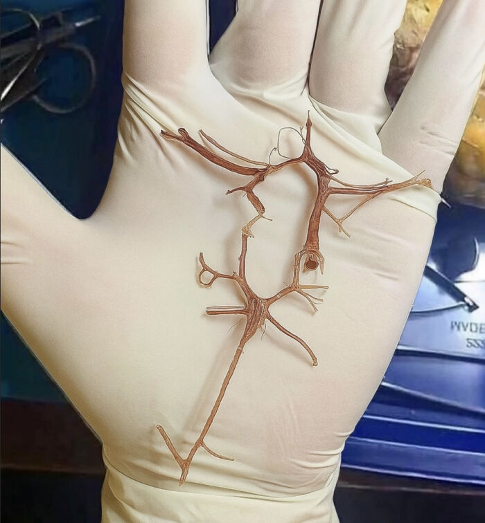 Latex-gloved hand holding a brown bronchial tree-shaped cast on palm, medical pics