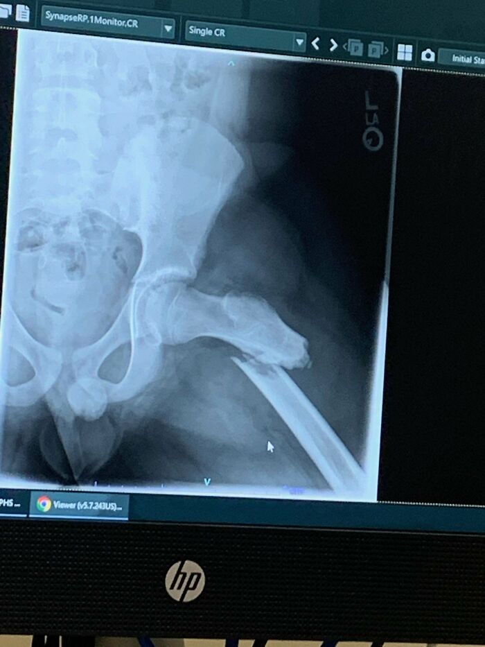 X-ray monitor showing displaced fractured femur and hip joint, medical pics
