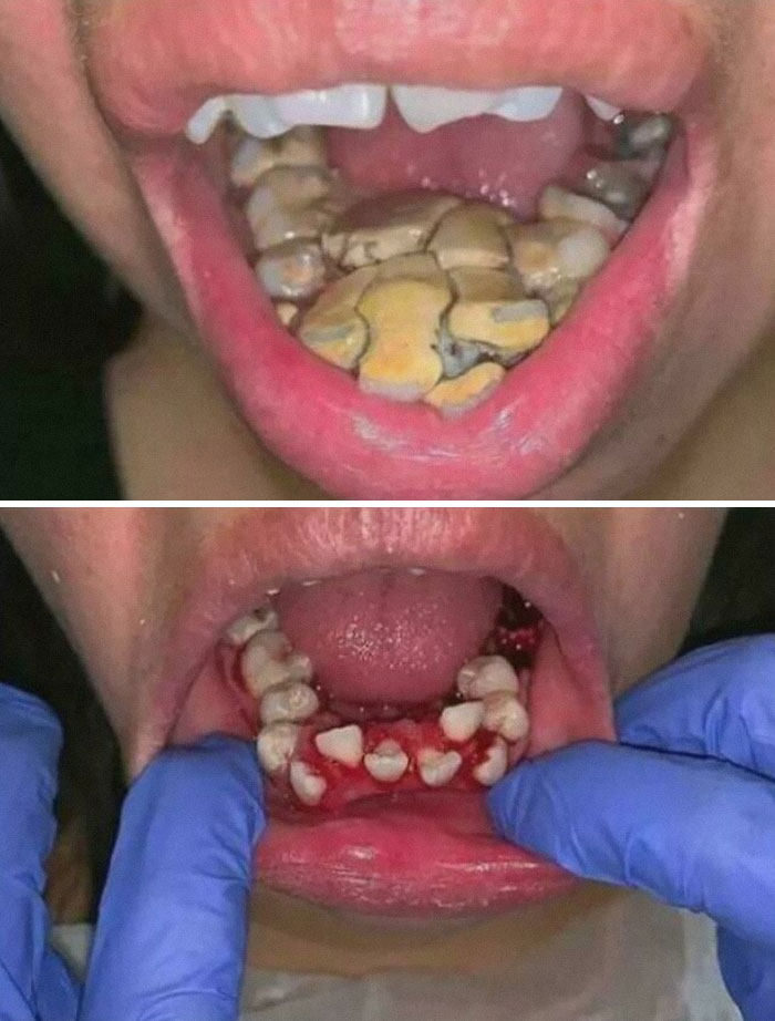 Close-up of unusual dental condition with severely decayed teeth and dental extraction shown in medical case.