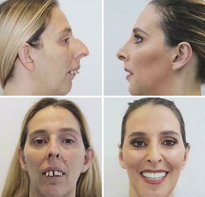 Before and after images of a medical case showing significant facial reconstruction and dental restoration transformation.