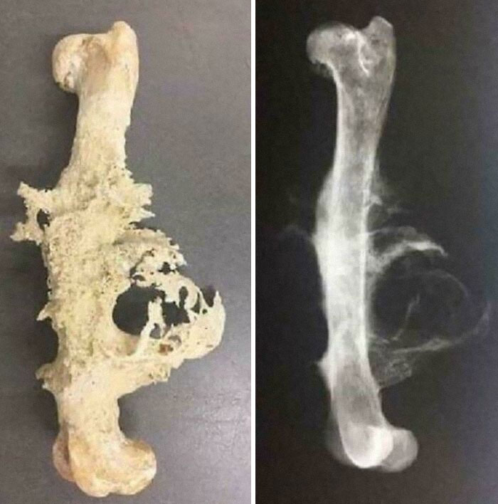 Deformed and eroded bone next to its X-ray image showing a rare medical case with gory details.