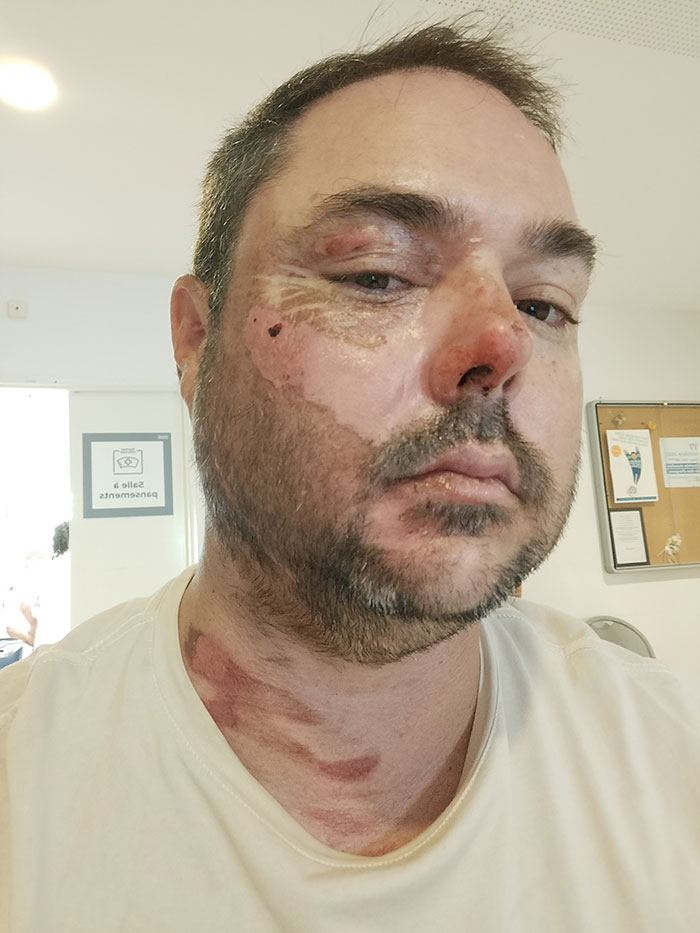 Man with visible burn scars on face and neck in a clinical setting following landmark domestic violence case.