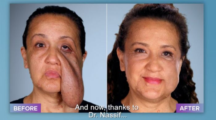 Before and after photos showing a plastic surgeon who fixes botched operations restoring a woman's facial appearance.