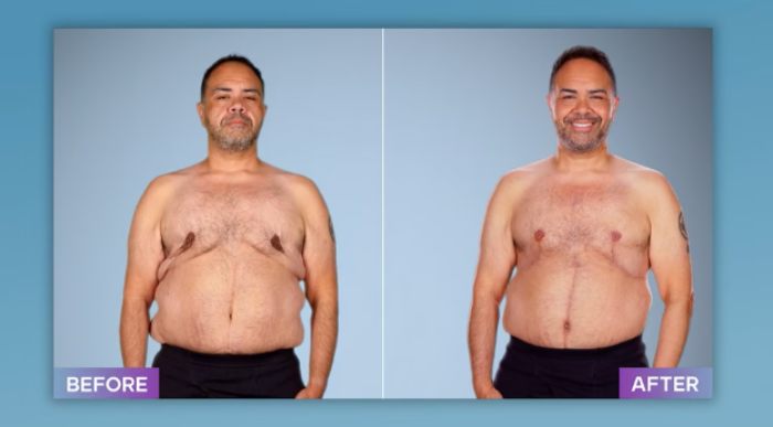 Man showing before and after results of plastic surgery by a surgeon who fixes botched operations, smiling in after photo.