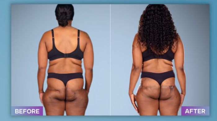 Before and after photos of a patient showing results from a plastic surgeon who fixes botched operations.
