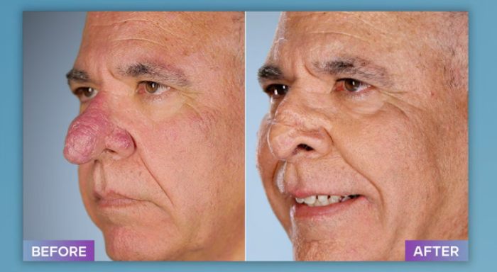 Before and after photos of a plastic surgeon who fixes botched operations showing significant facial correction results.