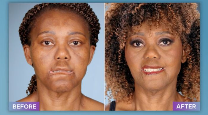 Before and after photos of a plastic surgeon who fixes botched operations showcasing dramatic facial improvements.