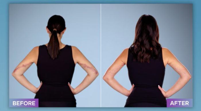 Before and after photos of a plastic surgeon who fixes botched operations showing improved arm and back appearance.