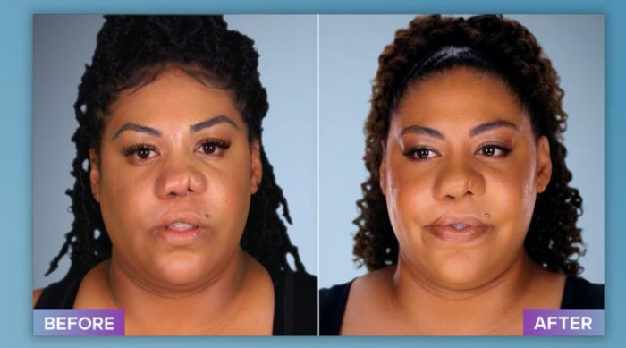 Before and after photos showing results of plastic surgeon who fixes botched operations on a woman with facial corrections.