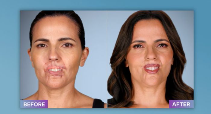 Before and after photos showing the results of a plastic surgeon who fixes botched operations on a female patient.