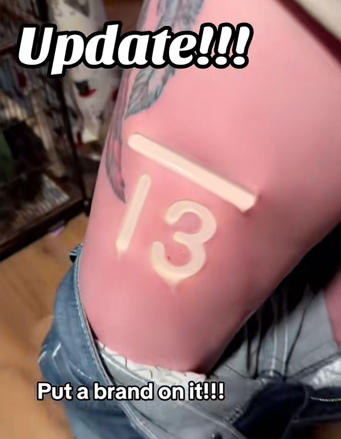 Person showing skin with trendy freeze brand tattoo alternative causing redness and raised marks on the torso. Person showing skin with trendy freeze brand tattoo alternative causing redness and raised marks on the torso.