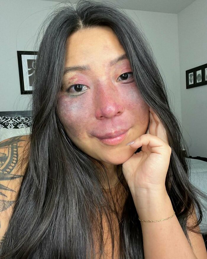 Woman with long dark hair showing a large, colorful birth mark on her face, smiling gently in a bedroom setting.