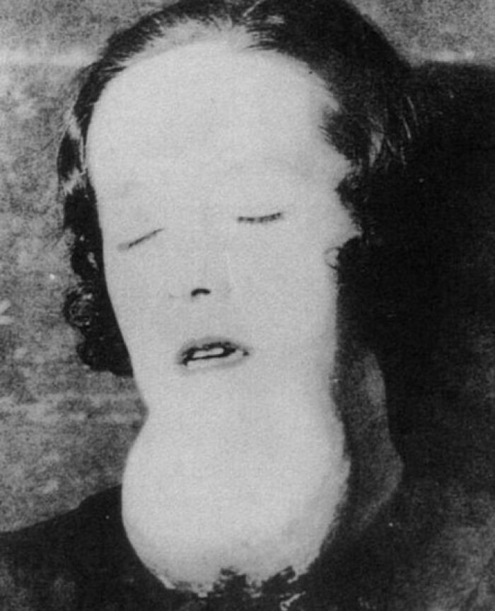 Black and white image showing a person with a swollen face and distorted features, an interesting fact that might surprise.