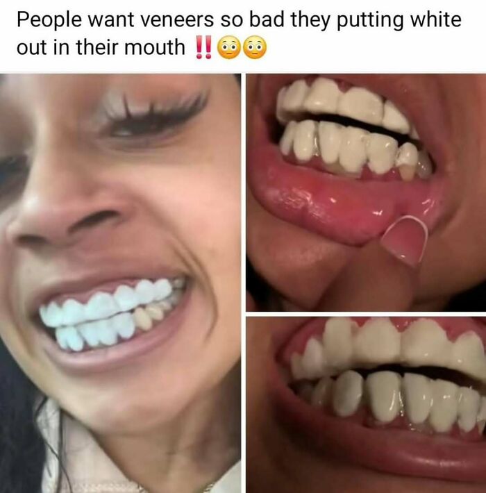 Collage of chaotic meme images showing people humorously placing fake white veneers over natural teeth.