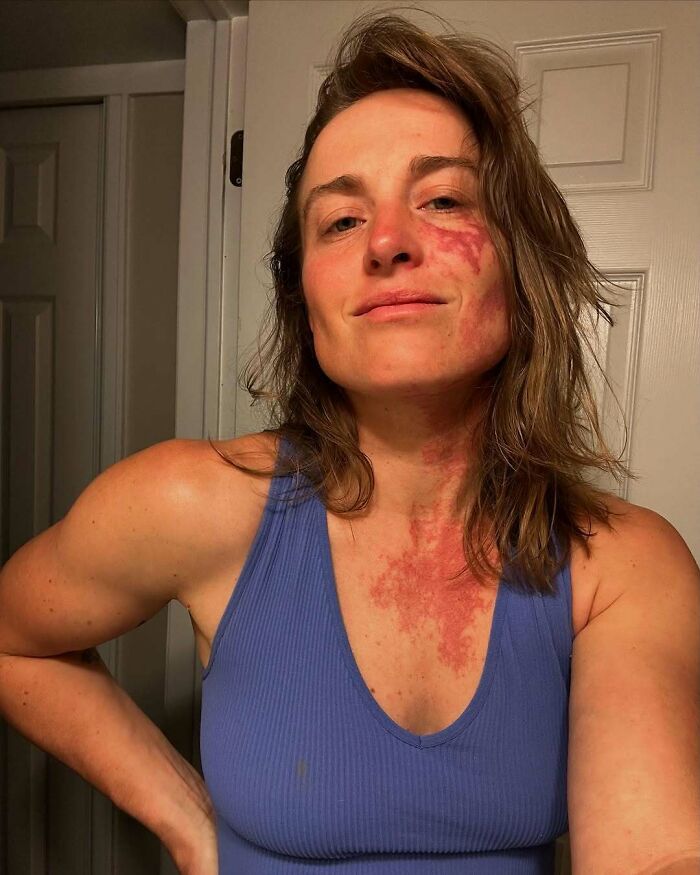 Woman with an interesting birth mark on her face and neck wearing a blue tank top posing confidently indoors