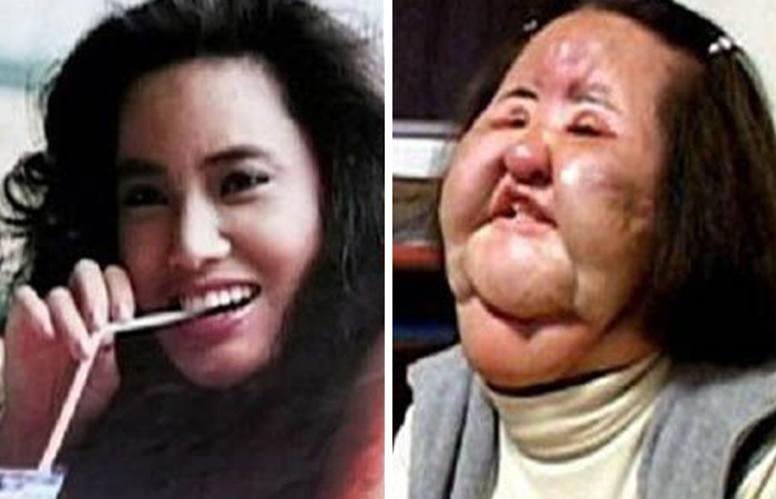Before and after photos of a woman showcasing dramatic changes from extreme plastic surgery transforming normal people to fame.