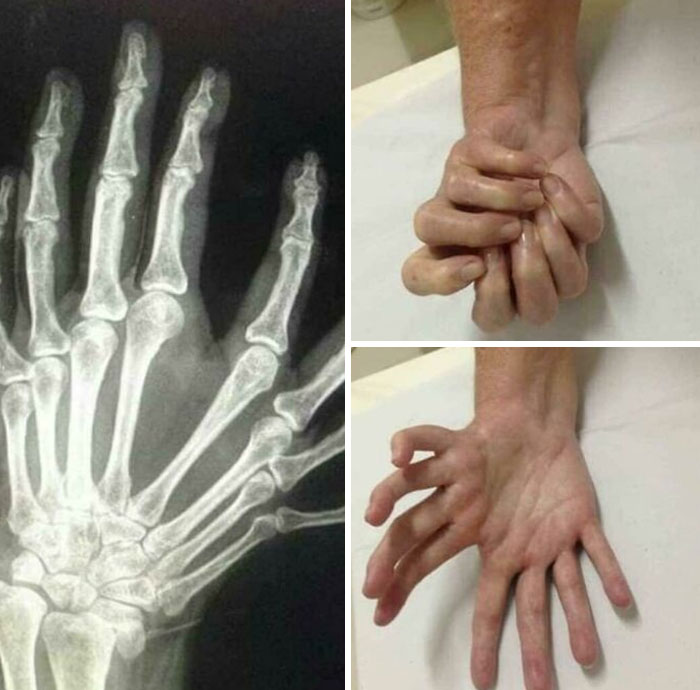 X-ray and photos of a hand with severe deformities showing bone abnormalities and unusual finger positions in medical images.