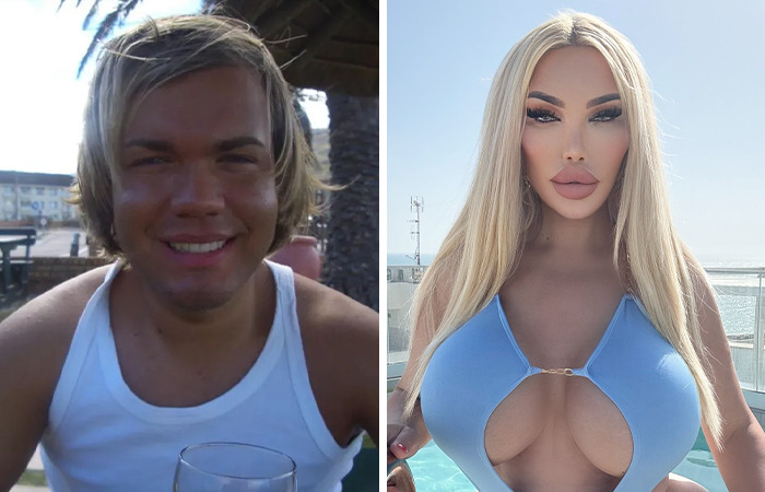 Before and after images of a person who gained fame after extreme plastic surgery transformation.