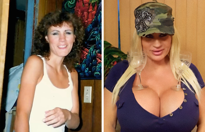 Before and after photos of normal people who gained fame following extreme plastic surgery transformations.