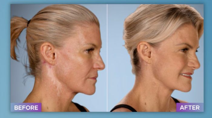 Before and after photos of a woman showing results from a plastic surgeon who fixes botched operations.