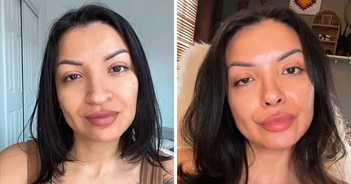 Woman showing before and after photos of her $6,640 nose job that she claims ruined her face due to vanity.
