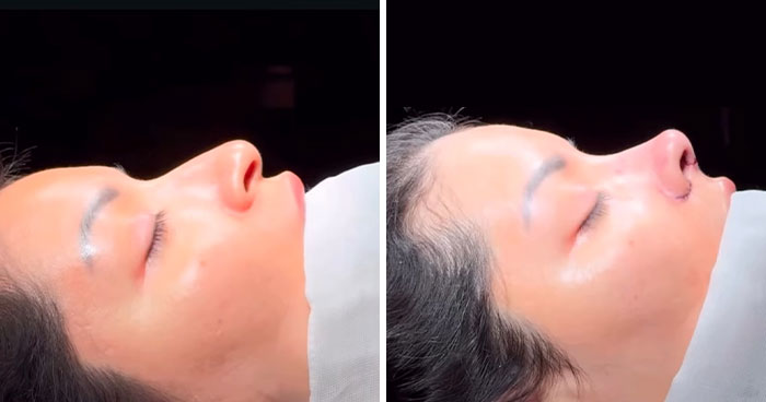 Side-by-side profile images of a woman showing before and after her $6,640 nose job that affected her face.