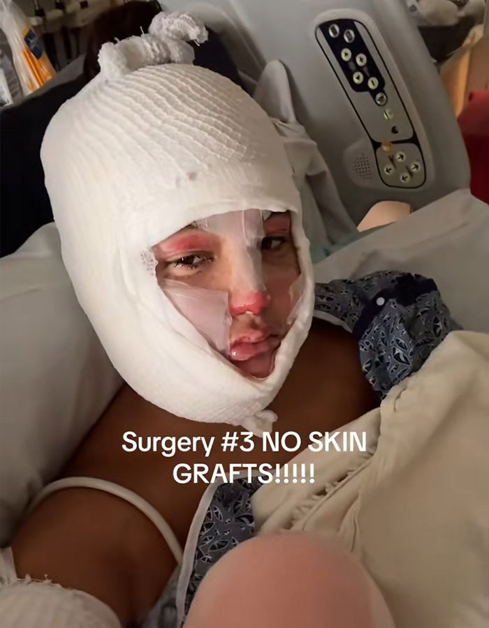 Teen with severe facial bandages lying in hospital bed after s’mores-making accident causing disfiguring injuries. - 5