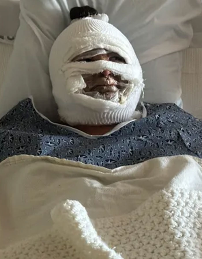 Teen with disfiguring injuries from s’mores-making accident resting in hospital bed with bandaged face and covered with blanket. - 2