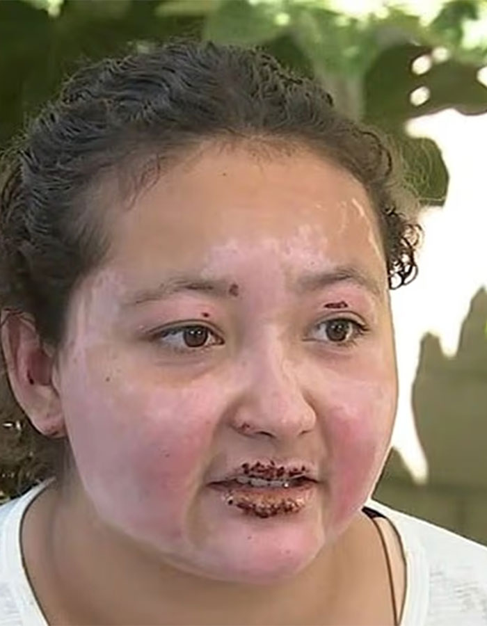 Teen with facial injuries from a s’mores-making accident, highlighting the need for a good product attorney. Teen with facial injuries from a s’mores-making accident, highlighting the need for a good product attorney.