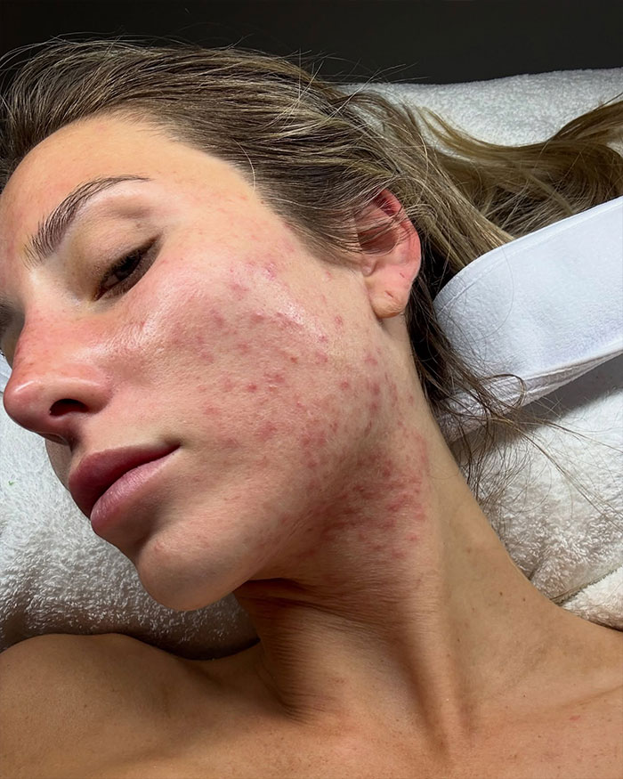 Close-up of Alix Earle's face showing skin texture and acne, related to Alix Earle&rsquo;s net worth discussion.