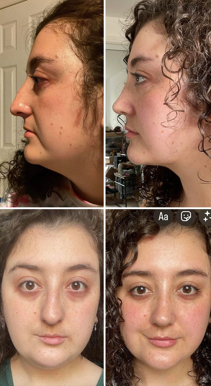 Before and after plastic surgery pics showing facial changes and improvements in skin and features of a woman.