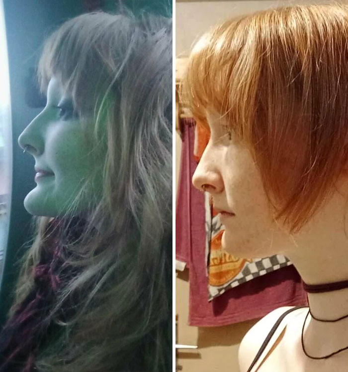 Before and after plastic surgery comparison of a woman showing significant facial transformation and profile changes.