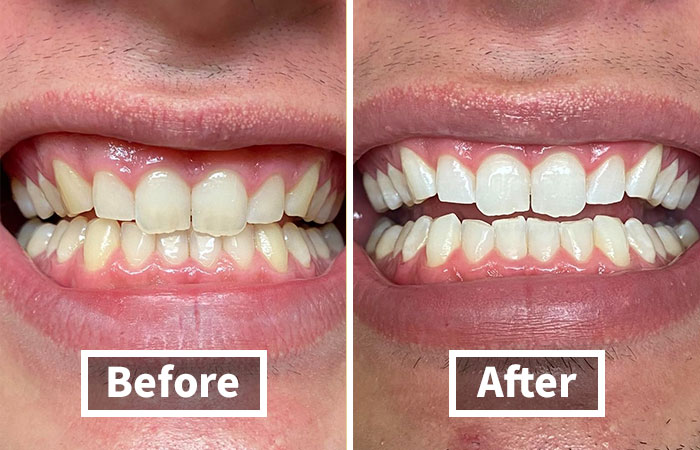 Before and after close-up of teeth whitening treatment showing brighter teeth as part of 20 deals on brands you know and love.